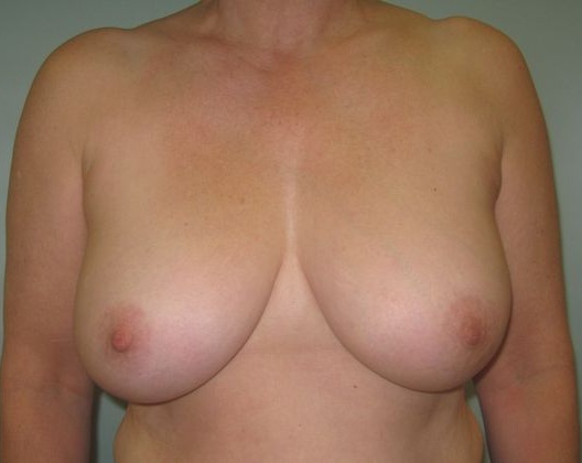 Breast reconstruction Before & After photo