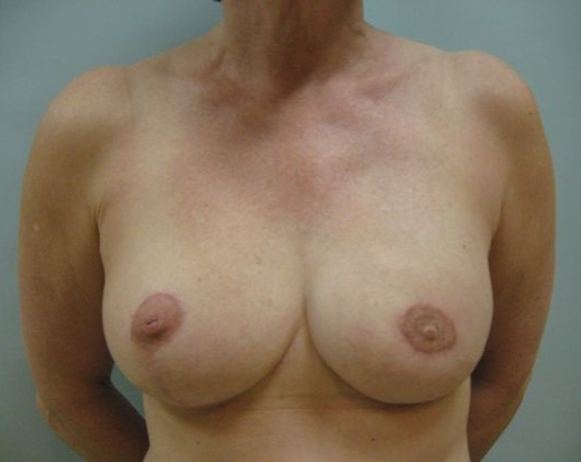Breast reconstruction before & after photo