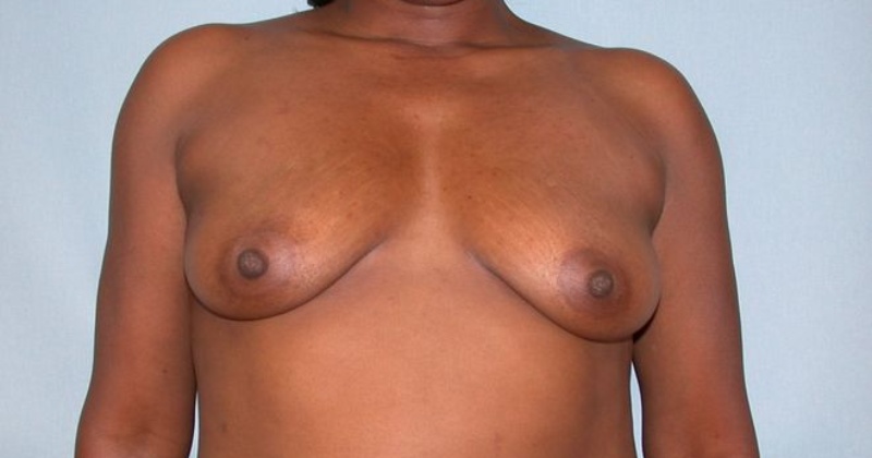 Breast reconstruction before & after photo