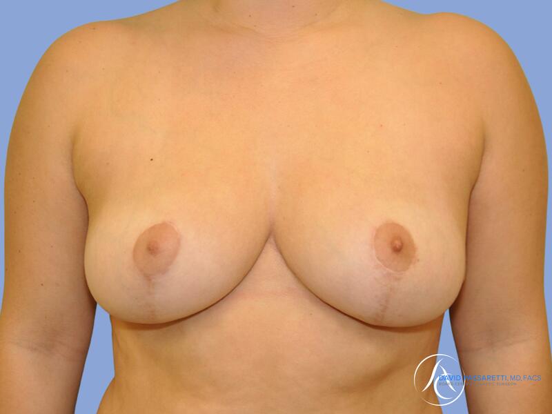 Breast reduction before & after photo