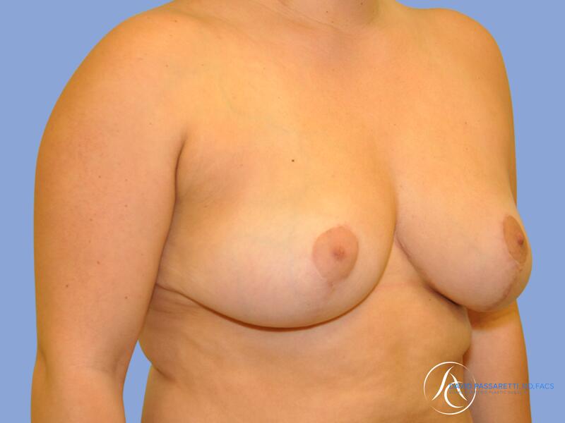 Breast reduction before & after photo