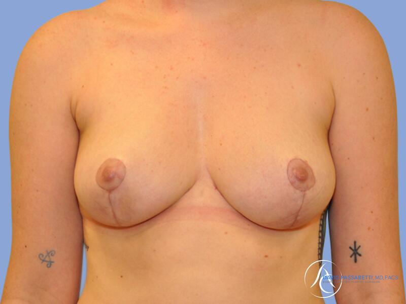 Breast reduction before & after photo