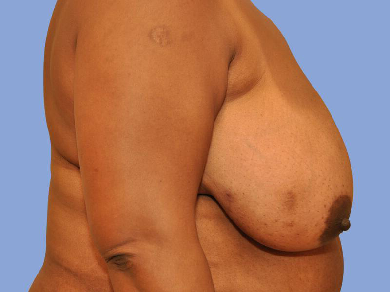 Breast reduction before & after photo