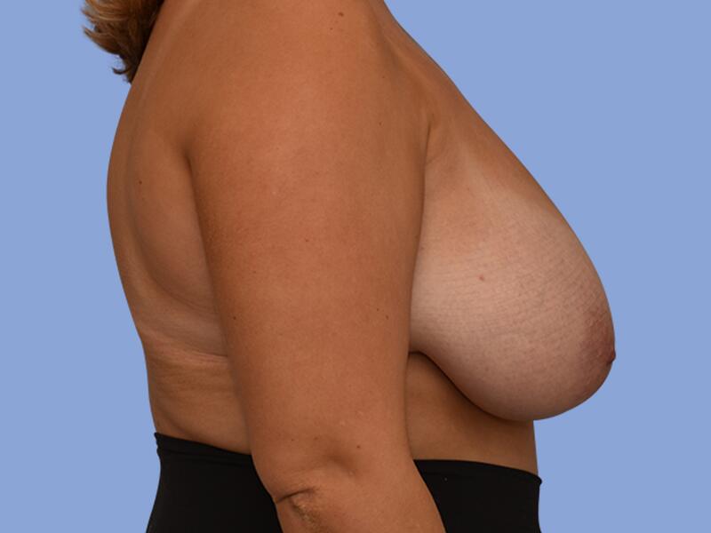 Breast reduction before & after photo