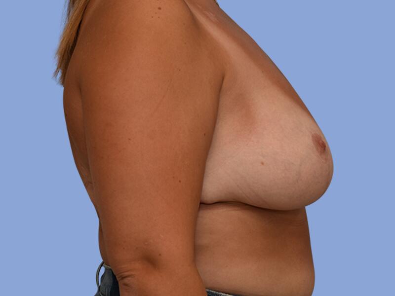 Breast reduction before & after photo