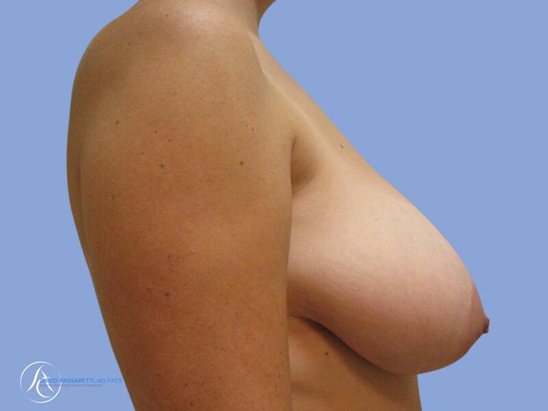 Breast reduction before & after photo