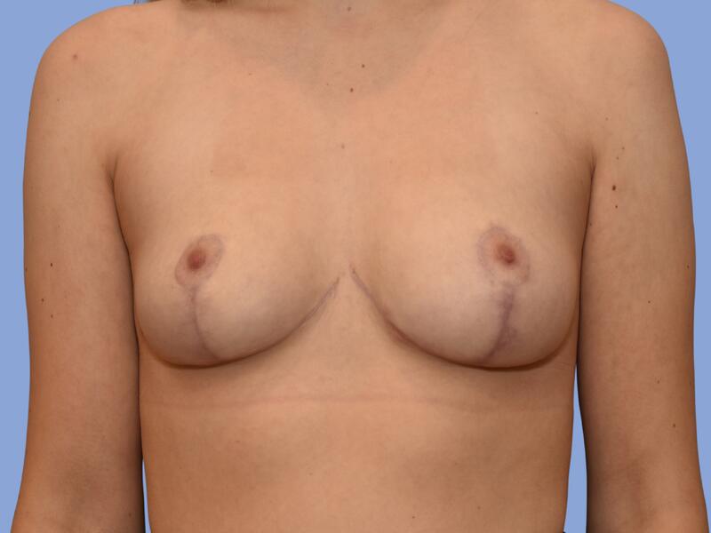 Breast reduction before & after photo