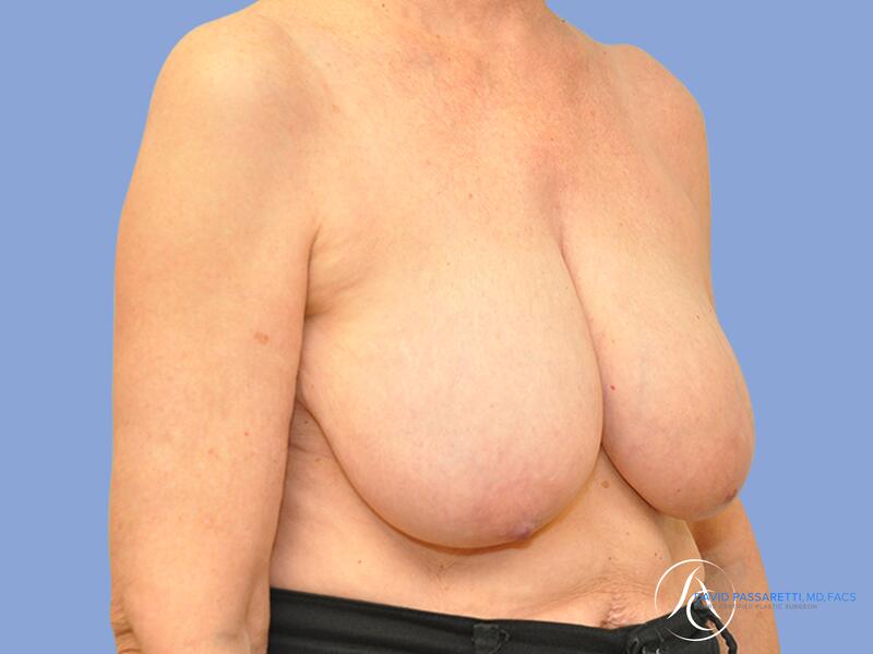 Breast reduction before & after photo