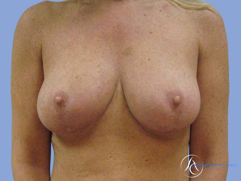 Breast reduction before & after photo