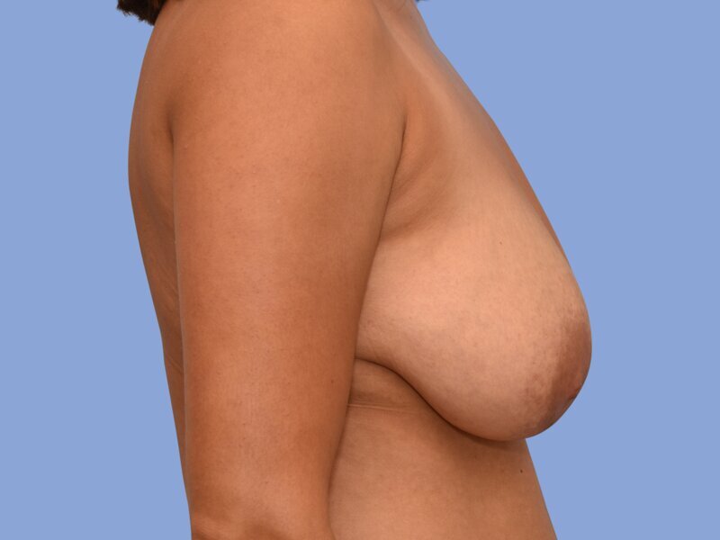 Breast reduction before & after photo