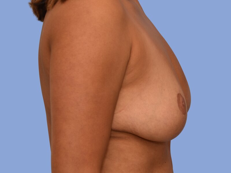 Breast reduction before & after photo