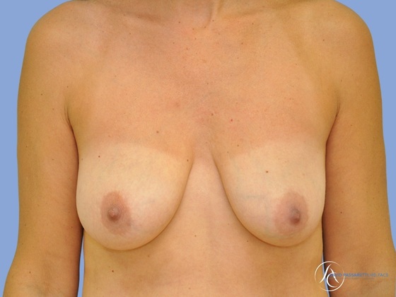 Breast reduction before & after photo