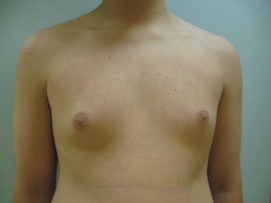 Male breast reduction before & after photo