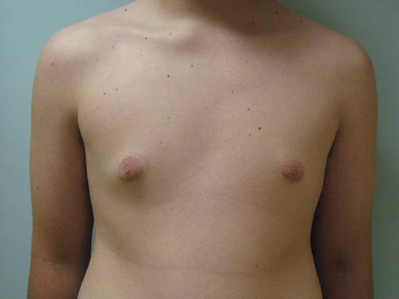 Male breast reduction before & after photo