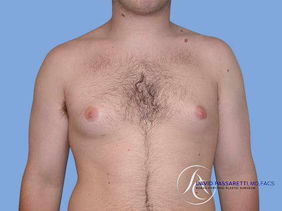 Male breast reduction before & after photo