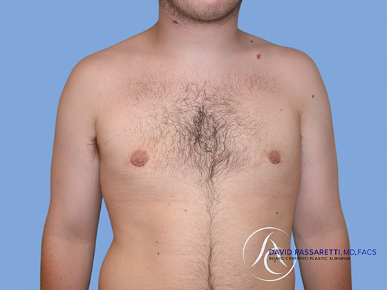 Male breast reduction before & after photo