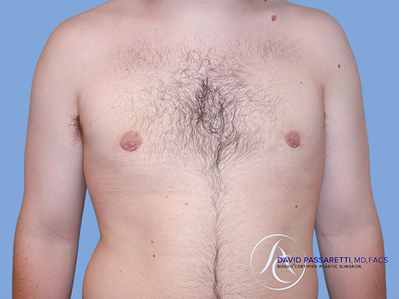 Male breast reduction before & after photo