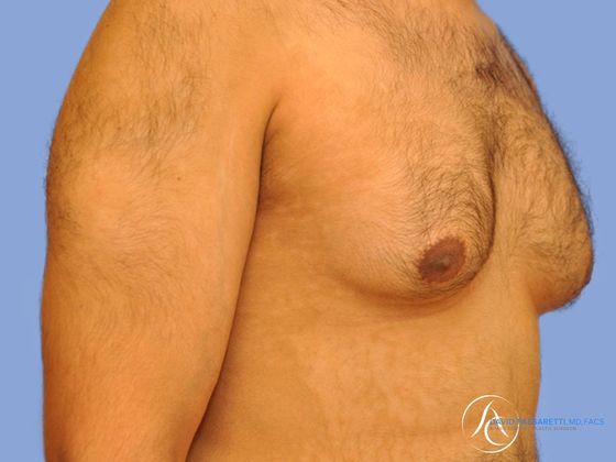 Male breast reduction before & after photo