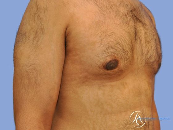 Male breast reduction before & after photo