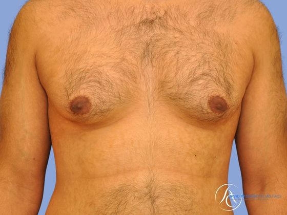 Male breast reduction before & after photo