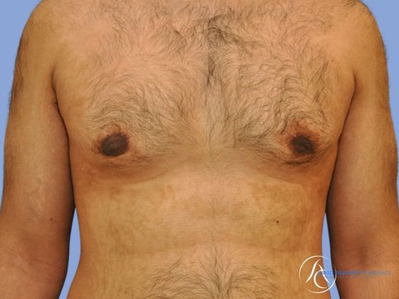 Male breast reduction before & after photo