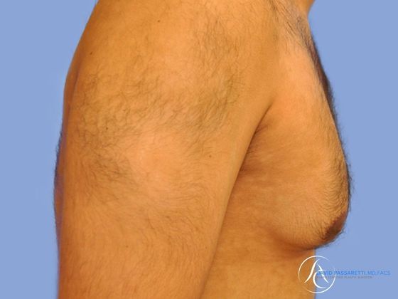 Male breast reduction before & after photo