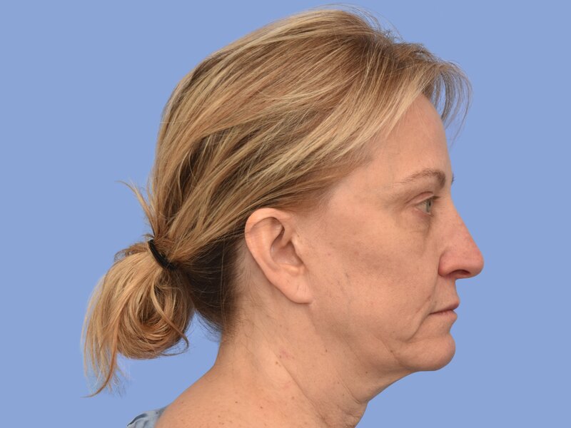 Brow lift before & after photo