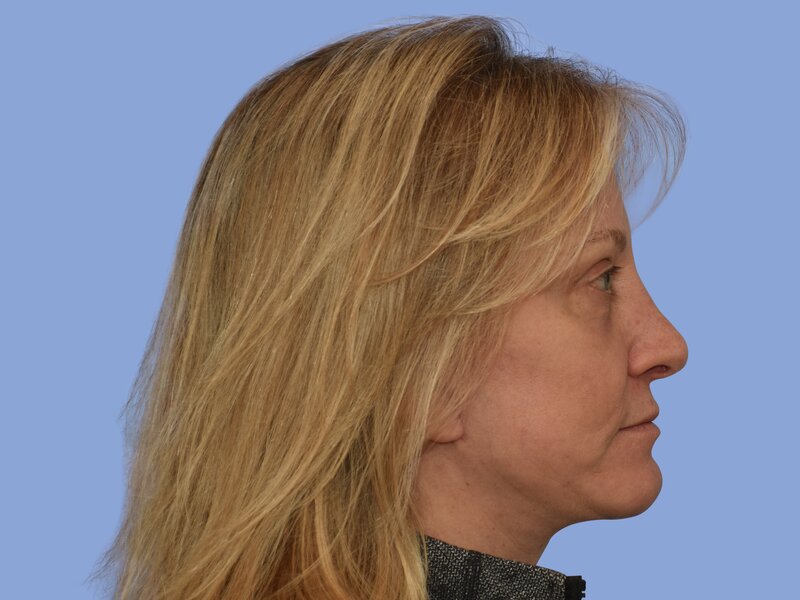 Brow lift before & after photo
