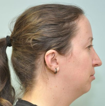 Chin augmentation before & after photo