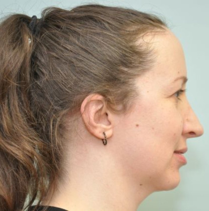 Chin augmentation before & after photo