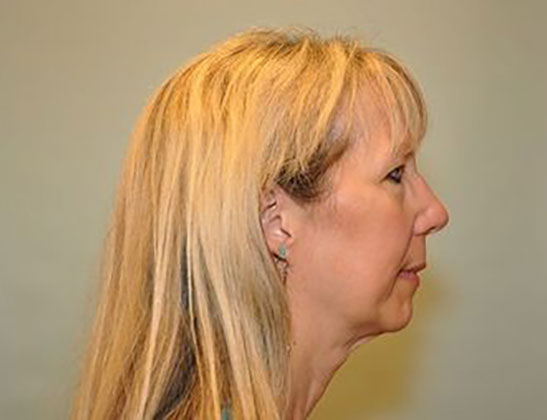 Chin augmentation Before & After photo