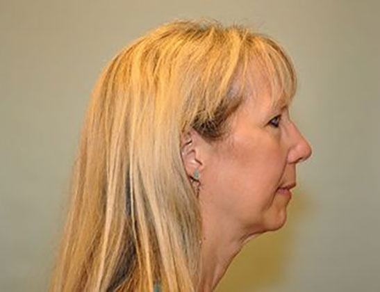 Chin augmentation before & after photo