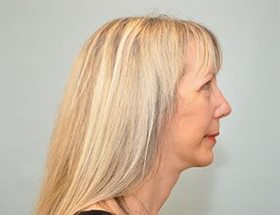 Chin augmentation before & after photo