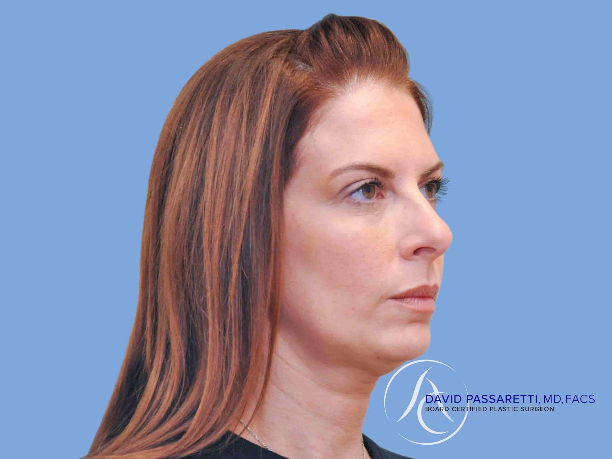 Chin augmentation before & after photo