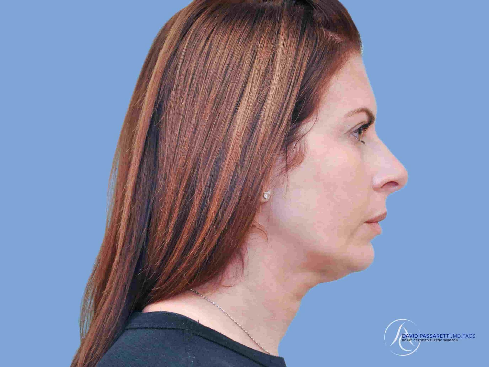 Chin augmentation before & after photo