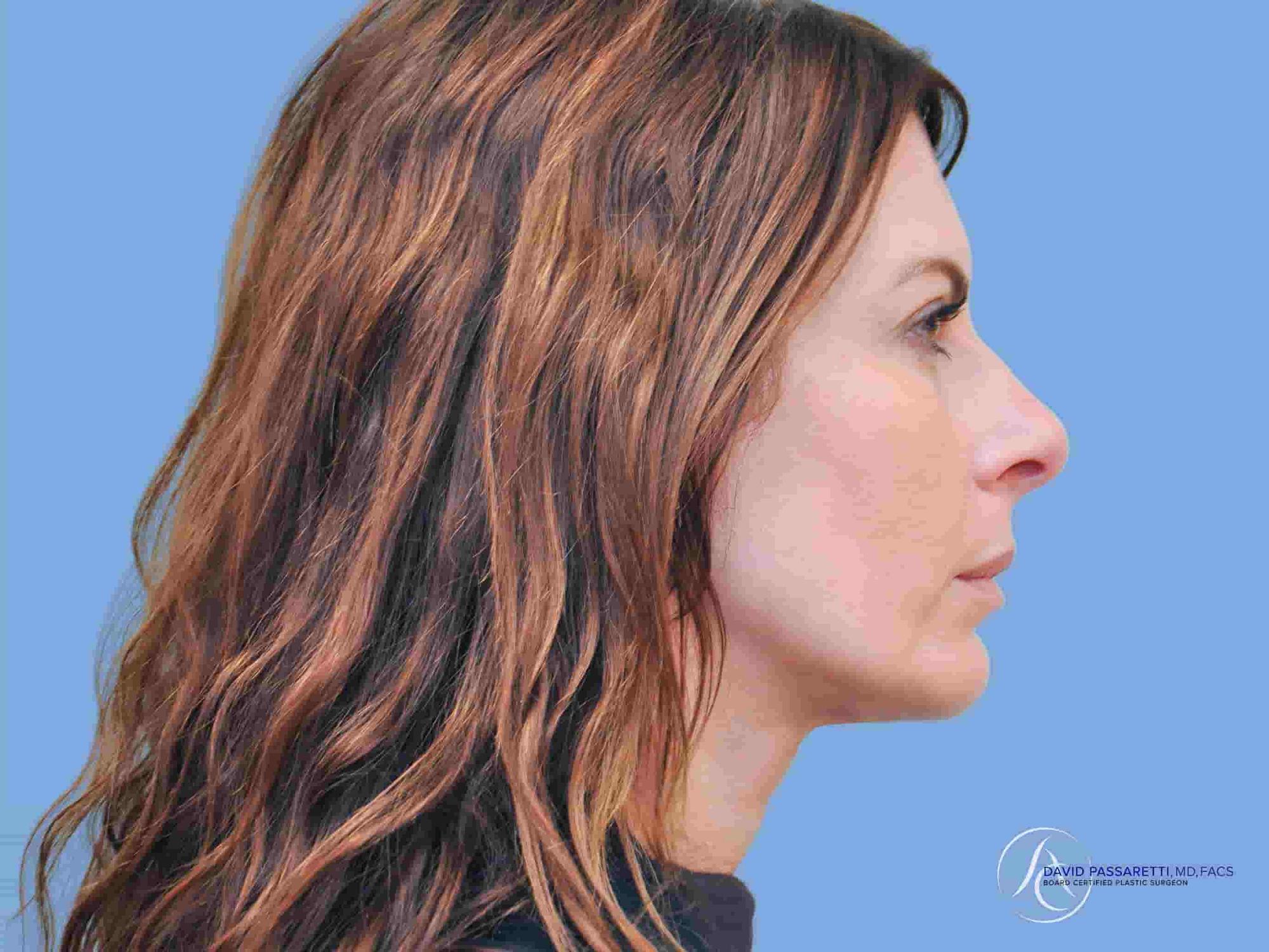 Chin augmentation before & after photo