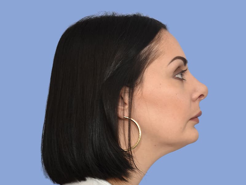 Chin liposuction before & after photo