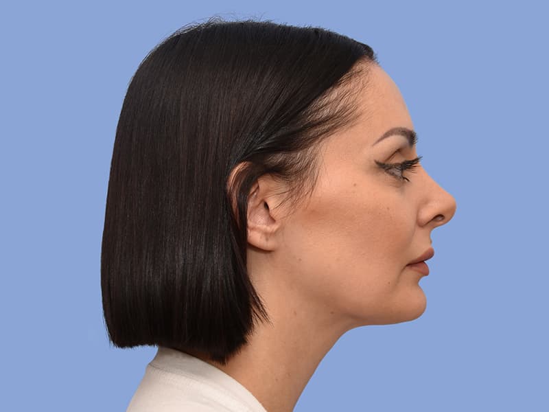 Chin liposuction before & after photo