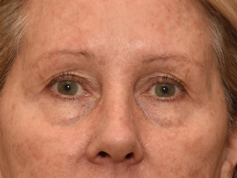 Eyelid surgery before & after photo