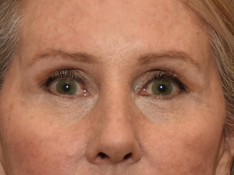 Eyelid surgery before & after photo