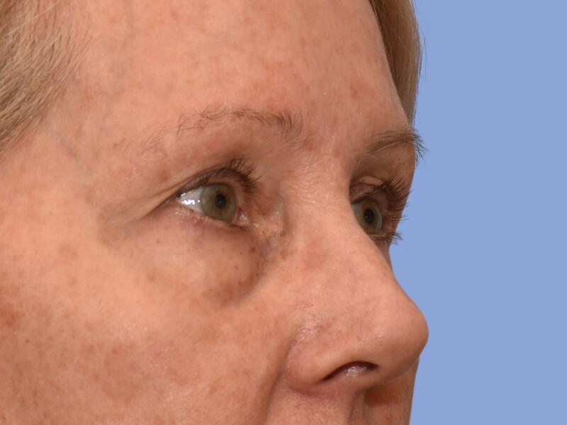 Eyelid surgery before & after photo