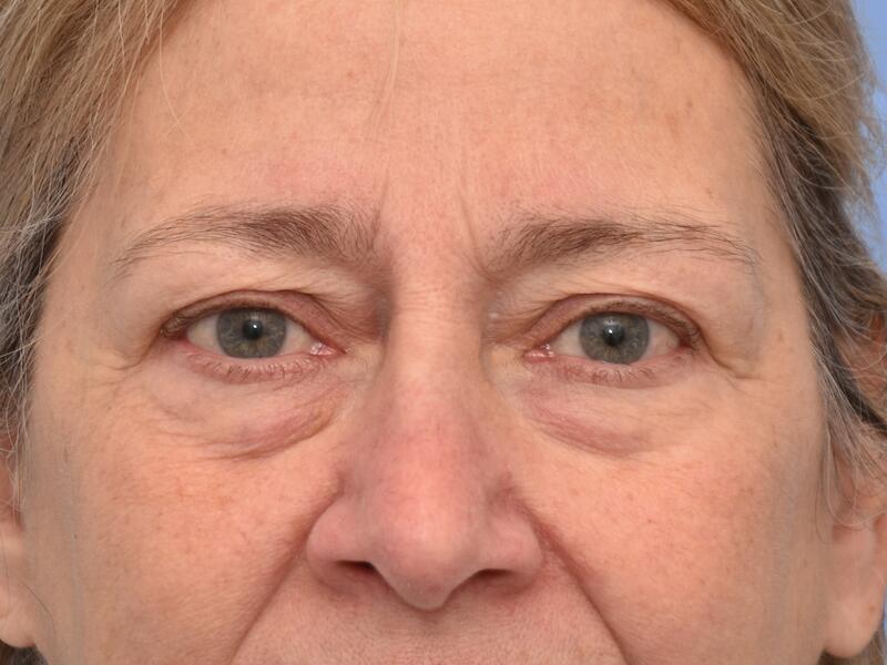 Eyelid surgery before & after photo