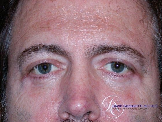 Eyelid surgery before & after photo