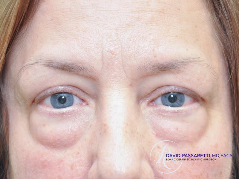 Eyelid surgery before & after photo