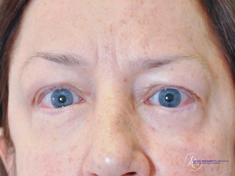 Eyelid surgery before & after photo