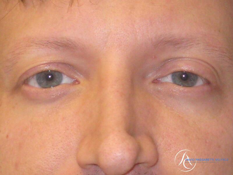 Eyelid surgery before & after photo