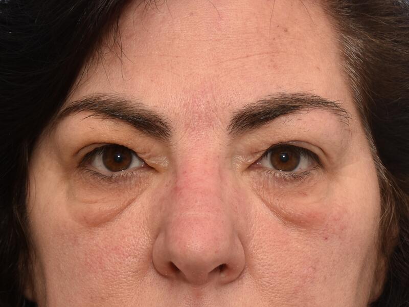 Eyelid surgery before & after photo