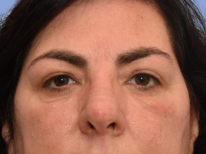 Eyelid surgery before & after photo