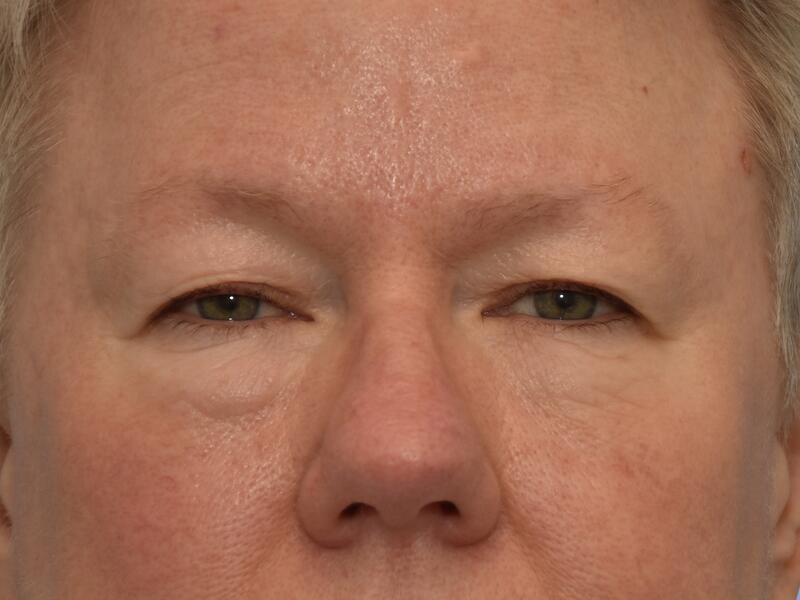 Eyelid surgery before & after photo