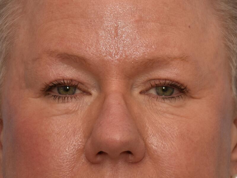 Eyelid surgery before & after photo